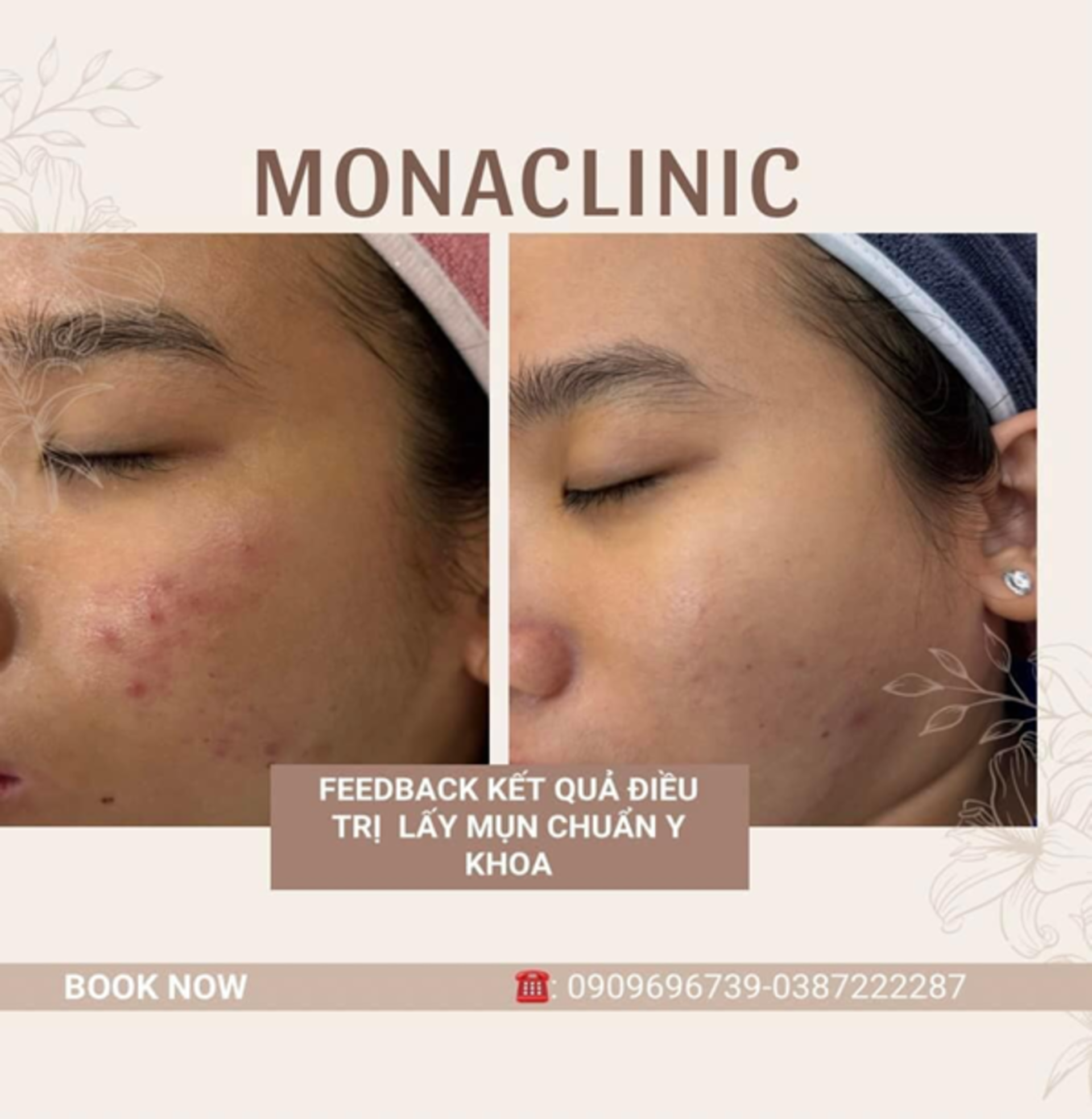 Trải Nghiệm Làm Đẹp Toàn Diện Tại Mona Clinic: Từ Chăm Sóc Da Đến Giảm Cân Hiệu Quả - ảnh 4