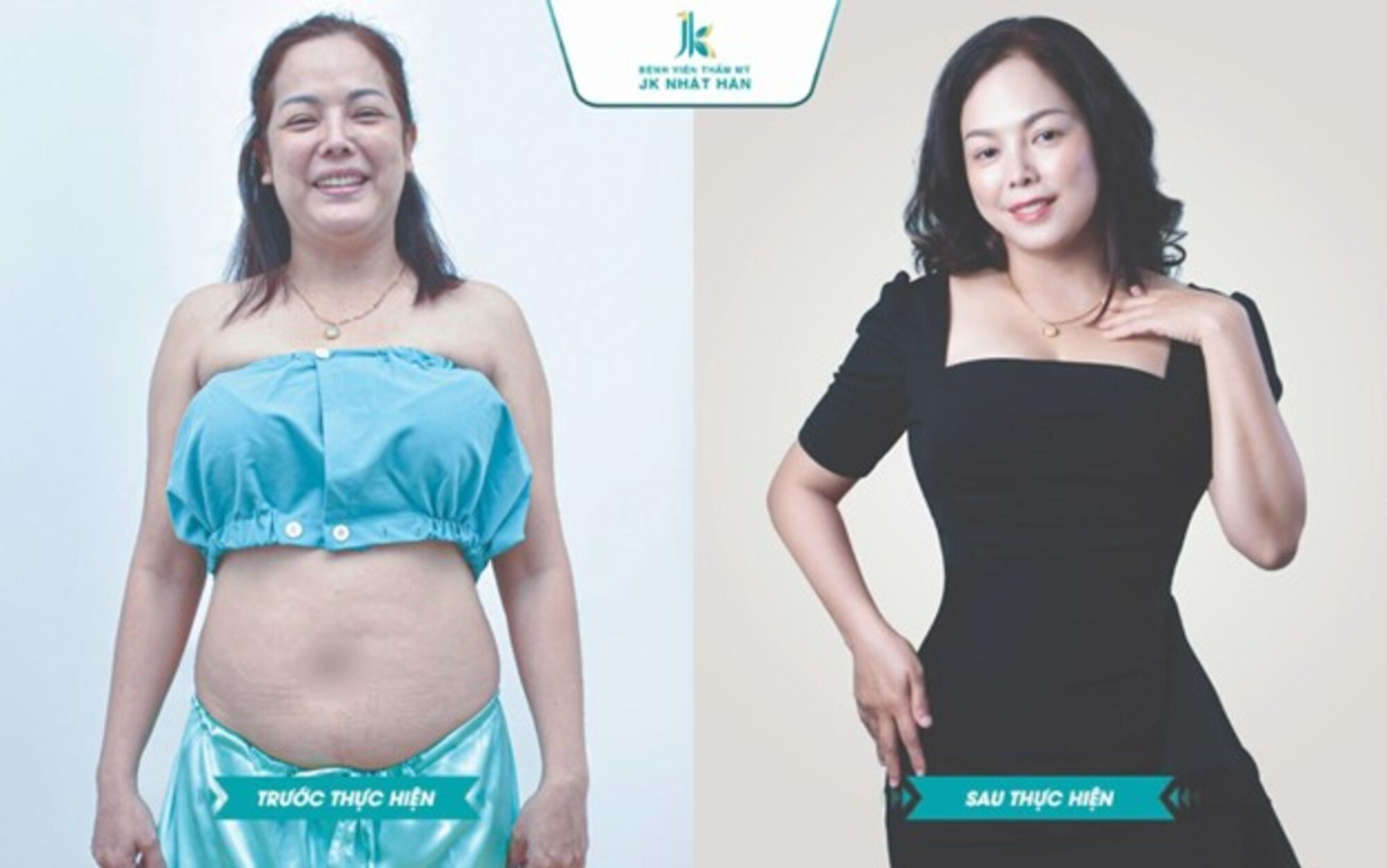 Giải pháp 'Tạo Hình Thành Bụng Nội Soi Ommi' Dành Cho Phụ Nữ Sau Sinh - ảnh 2
