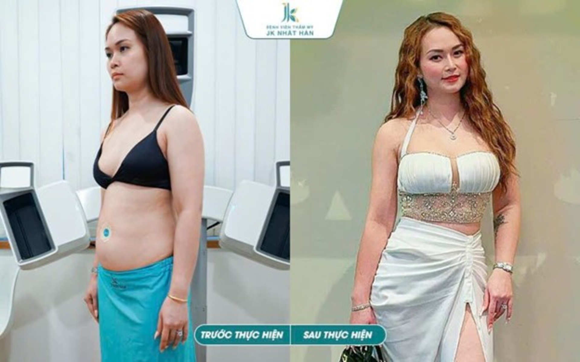 Giải pháp 'Tạo Hình Thành Bụng Nội Soi Ommi' Dành Cho Phụ Nữ Sau Sinh - ảnh 4