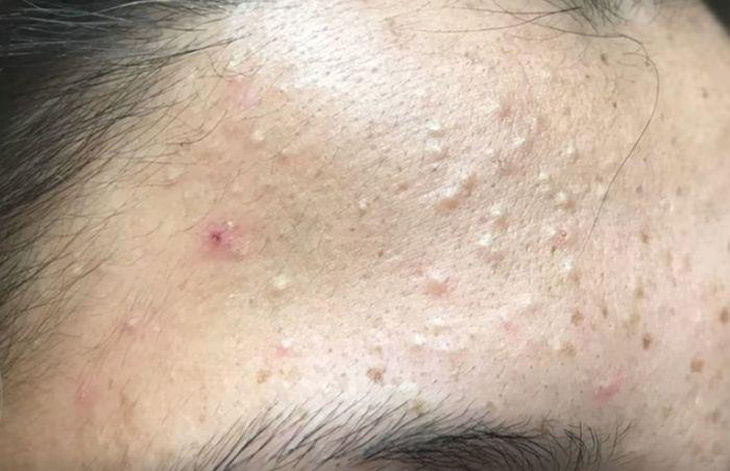 Mụn ẩn sau Tết: Nguyên nhân, cách khắc phục và giải pháp từ Actidem Derma Gel - ảnh 1