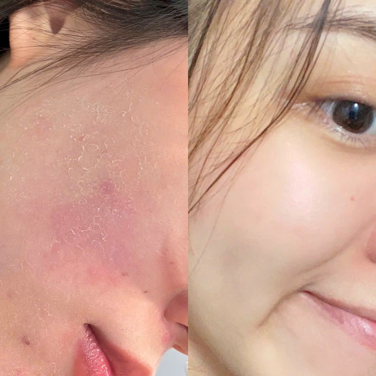 Trải nghiệm 30 ngày tạm biệt làn da nhạy cảm khó chiều cùng với gel rửa mặt Actidem Derma Sensitive - ảnh 4