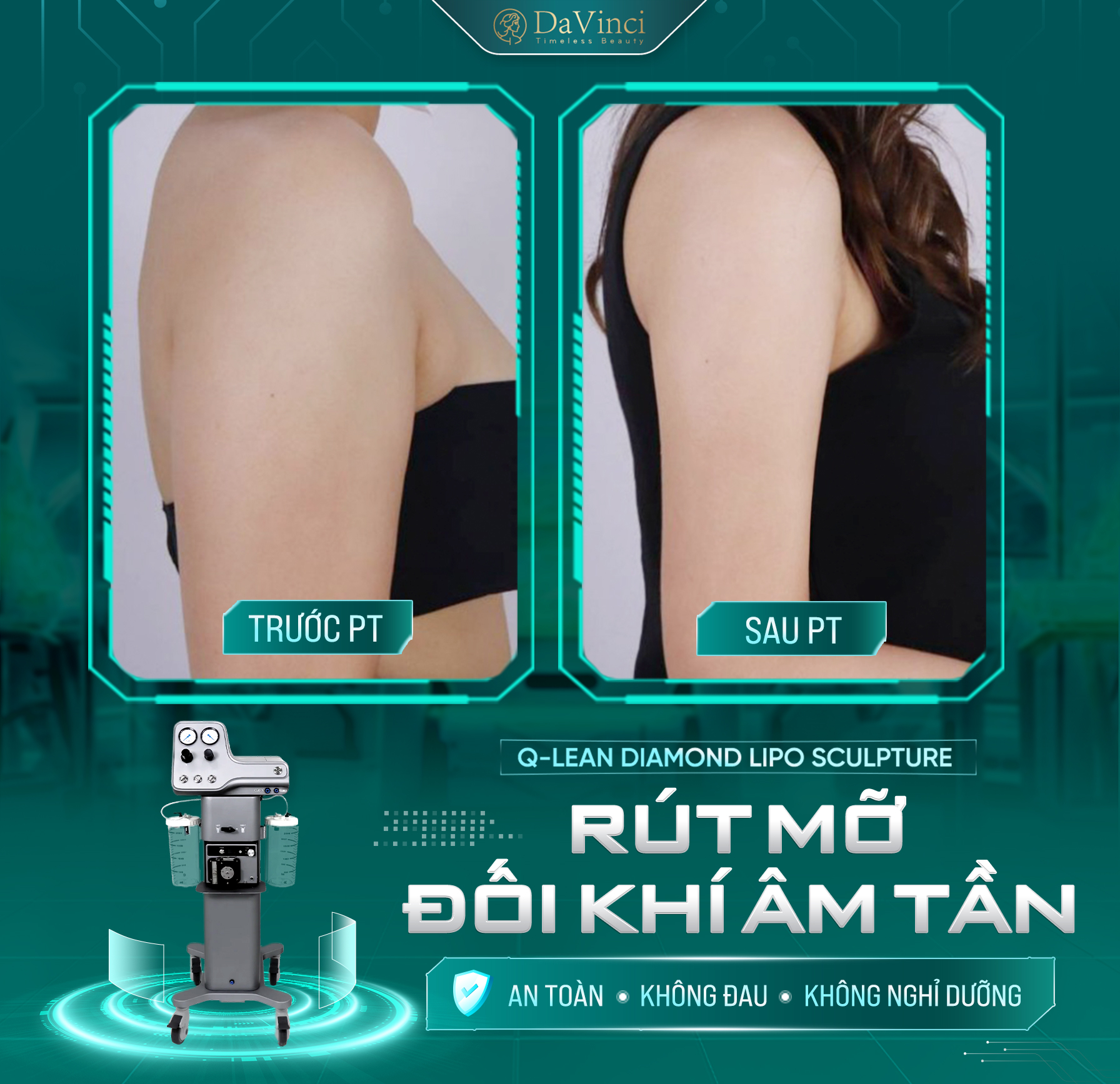 Giải Mã Công nghệ Rút Mỡ Đối Khí Âm Tần – Công Nghệ An Toàn Cho Vùng Mỡ “Khó Nhằn” - ảnh 1