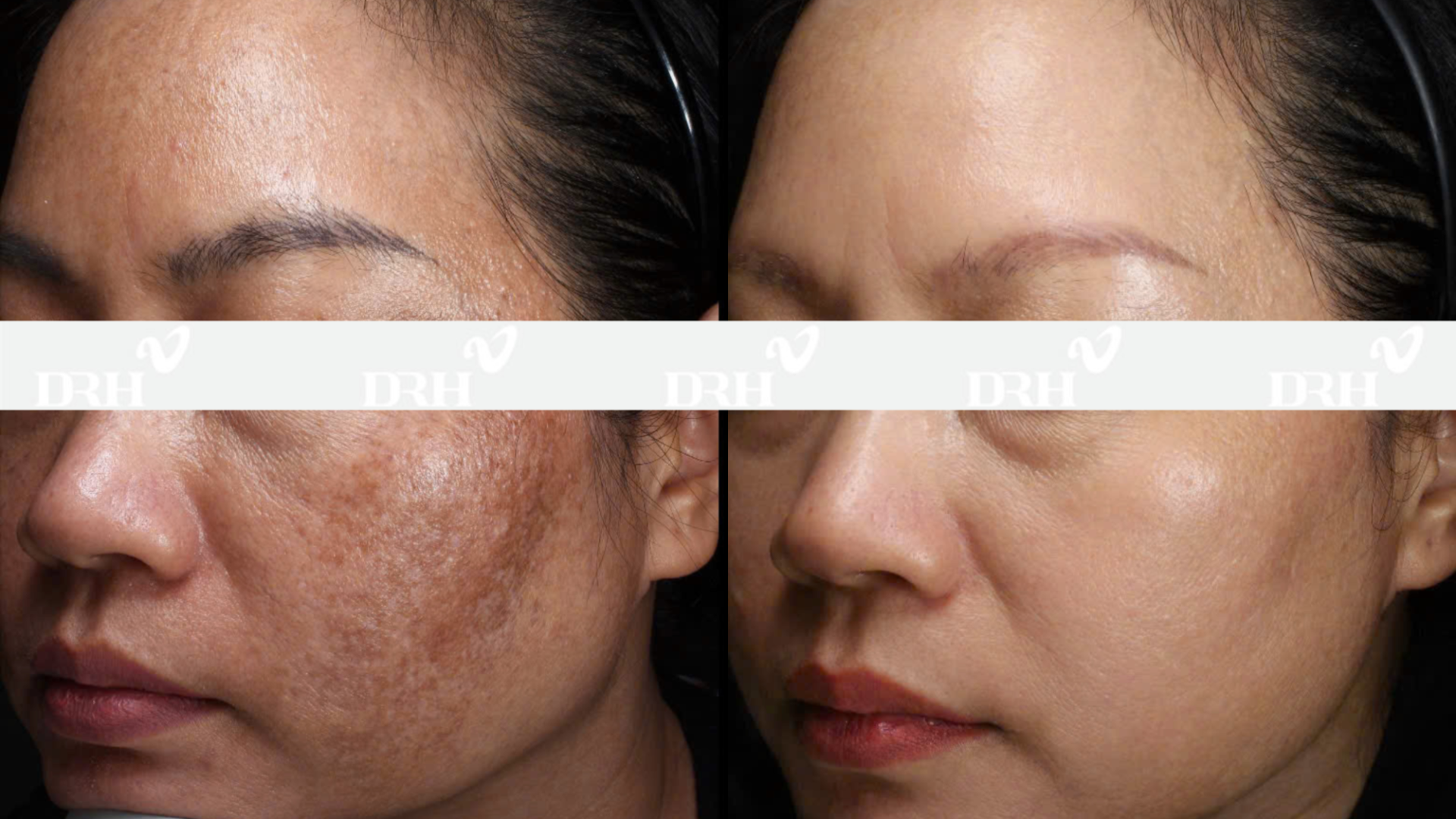 Biến Chứng Tràn Lan, Nhiều Người Việt Chọn DRH Clinic Làm Đẹp An Toàn Bền Vững - ảnh 2