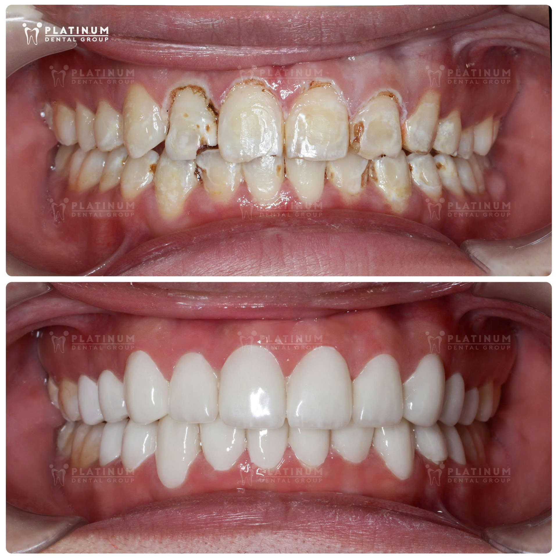 Bọc răng sứ thẩm mỹ: Khi nào nên và khi nào là sai lầm? - ảnh 2