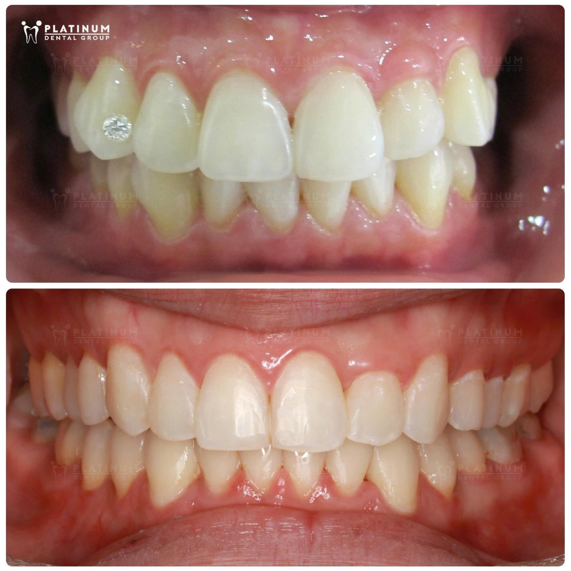 Bọc răng sứ thẩm mỹ: Khi nào nên và khi nào là sai lầm? - ảnh 3