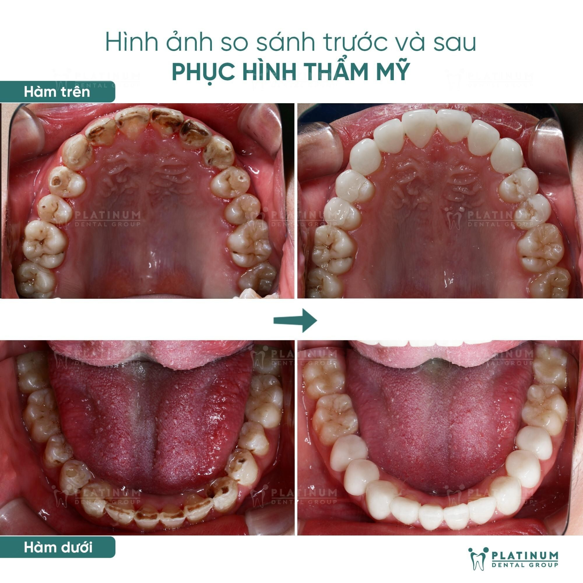 Bọc răng sứ thẩm mỹ: Khi nào nên và khi nào là sai lầm? - ảnh 4