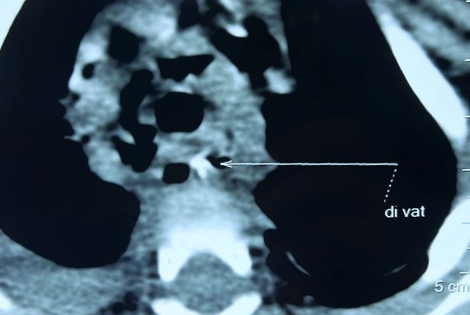 Hình CT scan phát hiện dị vật trong người bé gái (Ảnh: BV).