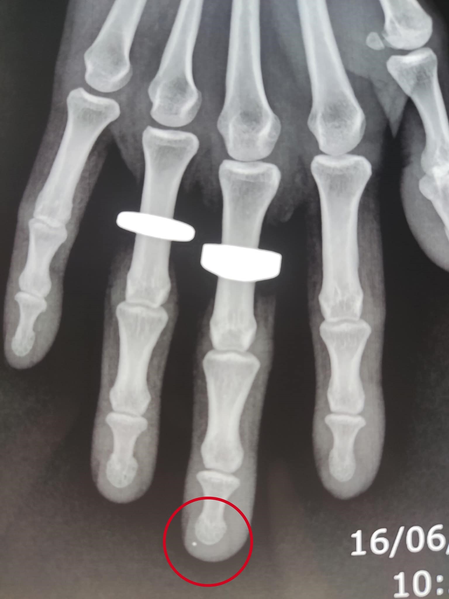 Ảnh X-quang chụp xương bàn tay bị kim khâu đâm