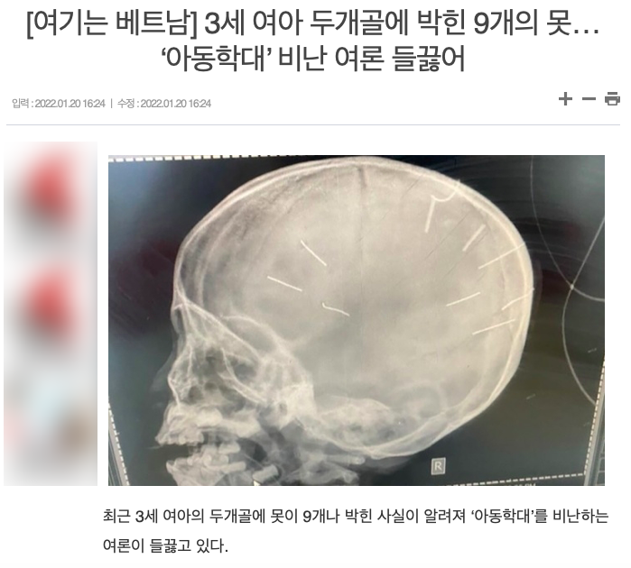 Truyền thông Hàn Quốc đưa tin về vụ việc cháu bé 3 tuổi nghi bị bạo hành với 9 đinh ghim trong hộp sọ