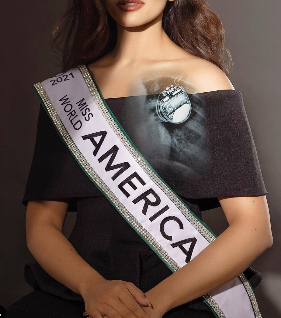 Á hậu Miss World 2021 lộ khuôn mặt từng bị bỏng nặng, không nhận ra nhan sắc hiện tại