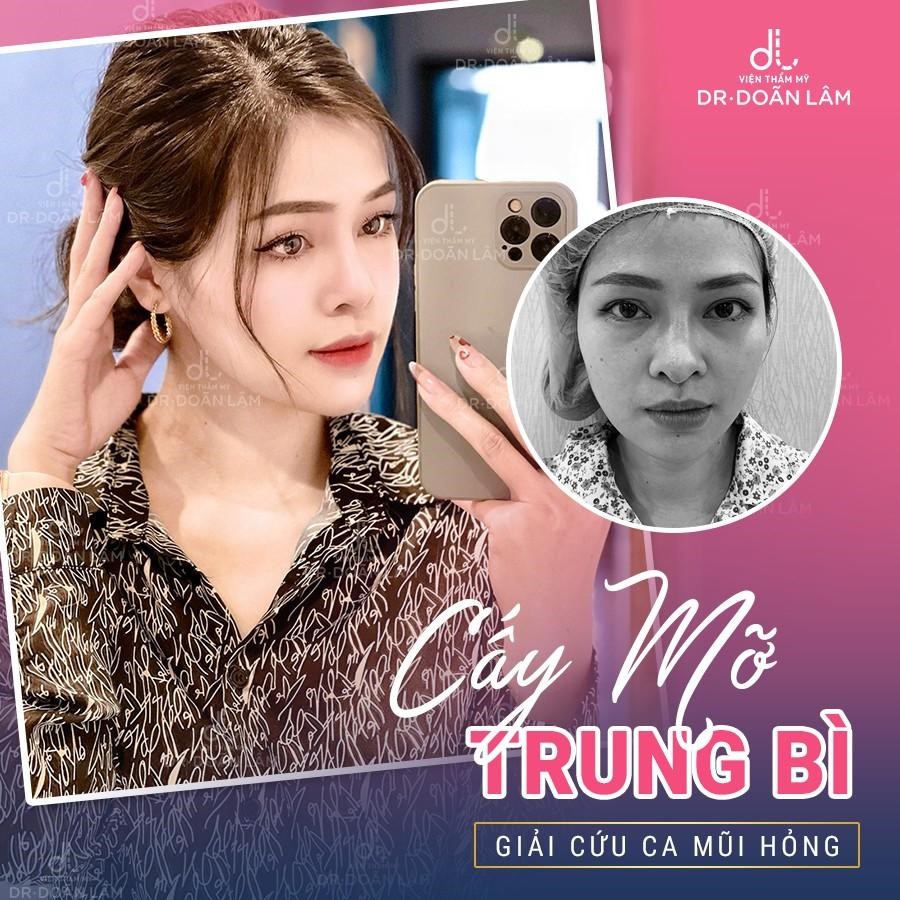 Dr Doãn Lâm - Chuyên gia giải cứu thành công những ca nâng mũi hỏng Dr Doãn Lâm - Chuyên gia giải cứu thành công những ca nâng mũi hỏng