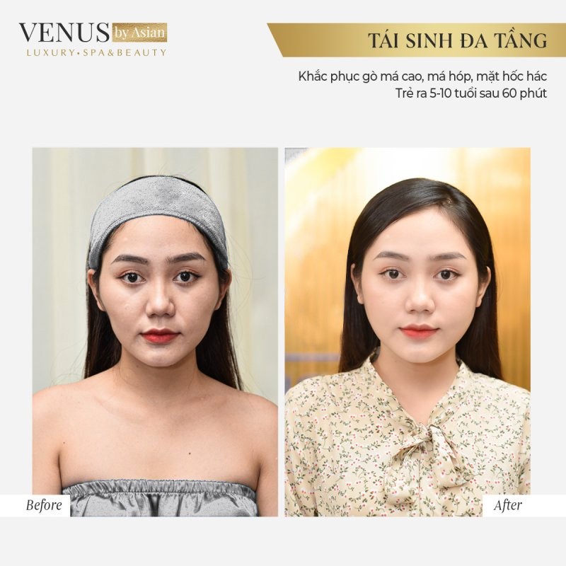 Phòng khám thẩm mỹ Venus by Asian dẫn đầu xu hướng làm đẹp không phẫu thuật