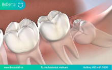 Nhổ răng khôn an toàn không biến chứng tại nha khoa thẩm mỹ Bedental