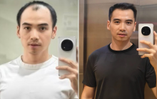 Diện mạo chồng H'Hen Niê sau nửa năm trị hói đầu