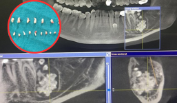Quảng Bình: Phát hiện 28 chiếc răng lớn nhỏ nằm chen chúc trong khối u răng của bé trai 9 tuổi