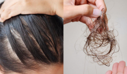 Nhiều người rụng tóc nhiều không rõ nguyên nhân, ăn 5 loại thực phẩm này, ngăn ngừa tóc rụng, phục hồi hư tổn