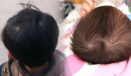 Trẻ em có 2 xoáy tóc rõ trên đầu khả năng thông minh hơn người khác, các bác sĩ lên tiếng?
