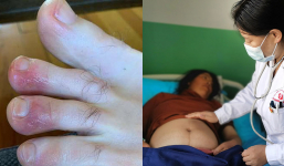 Người phụ nữ vào viện chữa 'tào tháo rượt' nhưng sau 9 ngày lại bị mất gần hết ngón tay, chân