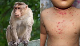 Bệnh đậu mùa khỉ có 2 ca mắc ở Đồng Nai - Bình Dương, từng được WHO cảnh báo nguy hiểm đến mức nào?