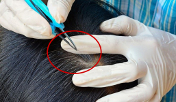 Người Việt thích nhổ tóc bạc nhưng đây là thói quen cực kỳ nguy hiểm chuyên gia khuyên bỏ ngay!