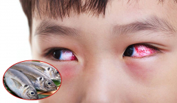 Bác sĩ cảnh báo người bị đau mắt đỏ phải tránh xa 7 loại thức ăn này nếu không muốn bệnh càng thêm nặng