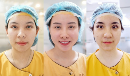 Dr.Hải Lê cắt sửa mí mắt lỗi hỏng 'tái sinh' nét đẹp phụ nữ Việt?