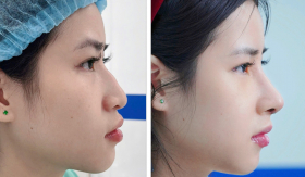 Nâng Mũi Cấu Trúc Cùng Bs.Nguyễn Xuân Long: Tối Ưu Hồi Phục Bằng Kỹ Thuật Xâm Lấn Tối Thiểu