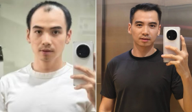 Diện mạo chồng H'Hen Niê sau nửa năm trị hói đầu