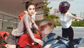 Ngọc Trinh đăng ảnh vết thương nặng khi bị chửi lái mô tô để đánh bóng tên tuổi