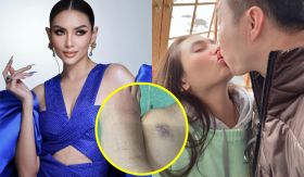 Giữa tin sắp lấy chồng Việt kiều, Võ Hoàng Yến để lộ dấu hiệu bầm dập chân tay: Chuyện gì đây?
