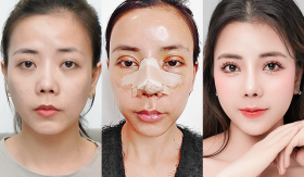 Chi 500 triệu “Dao Kéo” tại Việt Nam, nhan sắc 9x thay đổi ra sao