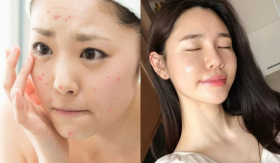 Vì sao có những người không bao giờ nổi mụn?