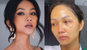 H'Hen Niê gây hoang mang khi mặt xuất hiện nhiều vết bầm tím, nguyên nhân được chính chủ hé lộ?