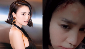 Nửa đêm, Ninh Dương Lan Ngọc bỗng đăng ảnh bị thương ở đầu khiến fan hoang mang: 'Chuyện gì đây?'