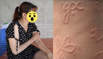 Hai người phụ nữ sở hữu làn da có thể viết chữ, vẽ tranh nổi lên như 3D, bác sĩ không tìm ra nguyên nhân