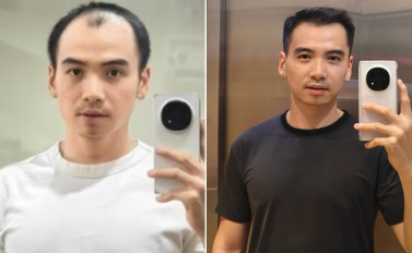 Diện mạo chồng H'Hen Niê sau nửa năm trị hói đầu