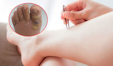 Chỉ vì nhổ một sợi lông mọc ngược ở chân, cô gái nhập viện cấp cứu điều trị 1 tuần không khỏi
