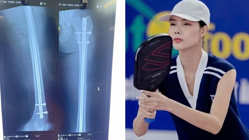 Bị gãy xương đùi khi chơi Pickleball, ca mổ của siêu mẫu Kỳ Hân phức tạp hơn vì chân quá dài