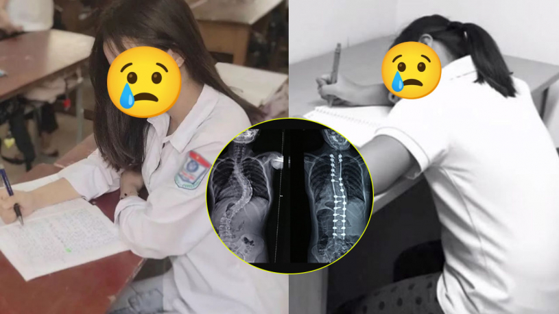 Ngồi học sai tư thế nhiều năm, nữ sinh bị cong vẹo cột sống phải bắt 22 chiếc vít để nắn lại