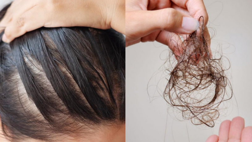 Nhiều người rụng tóc nhiều không rõ nguyên nhân, ăn 5 loại thực phẩm này, ngăn ngừa tóc rụng, phục hồi hư tổn