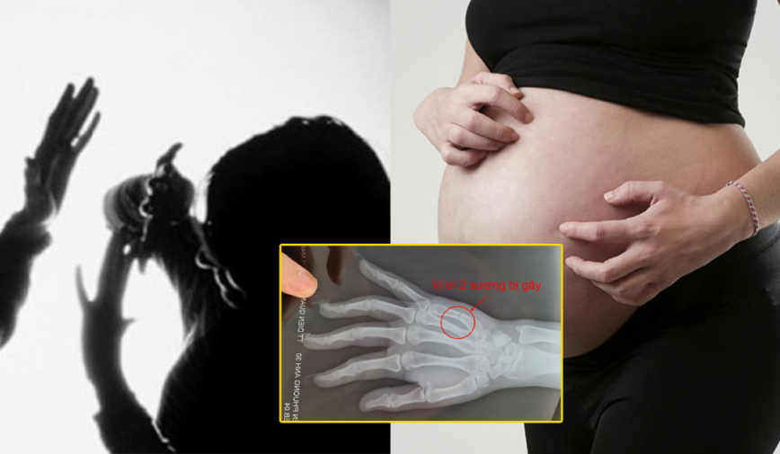 Công an vào cuộc điều tra vụ người phụ nữ ở Hà Nội bị đ.ánh s.ảy t.hai vì tranh chấp chỗ đỗ xe