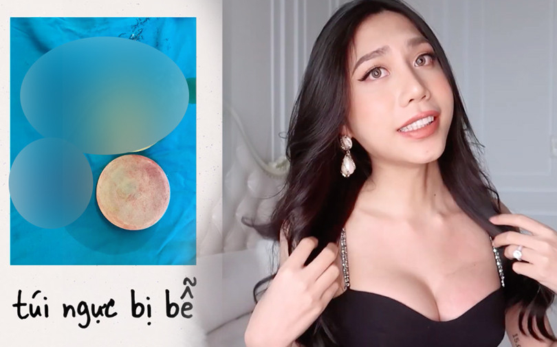 Mỹ nhân chuyển giới là 'chị em sinh đôi' của Lynk Lee chia sẻ quá trình làm ngực bị vỡ khiến CĐM hoang mang