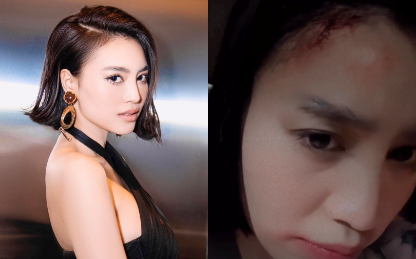 Nửa đêm, Ninh Dương Lan Ngọc bỗng đăng ảnh bị thương ở đầu khiến fan hoang mang: 'Chuyện gì đây?'