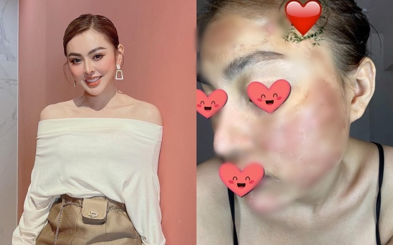 Trang Nemo vui vẻ tổ chức sinh nhật cho chồng giữa nghi vấn bị khách tố dùng peel da hỏng cả mặt